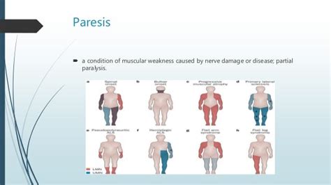 paraparesis vs hemiparesis.